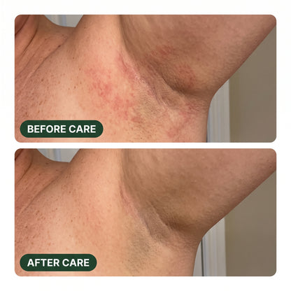 Tea Tree Antifungal Soap Bar – Deep Cleansing Skin Care