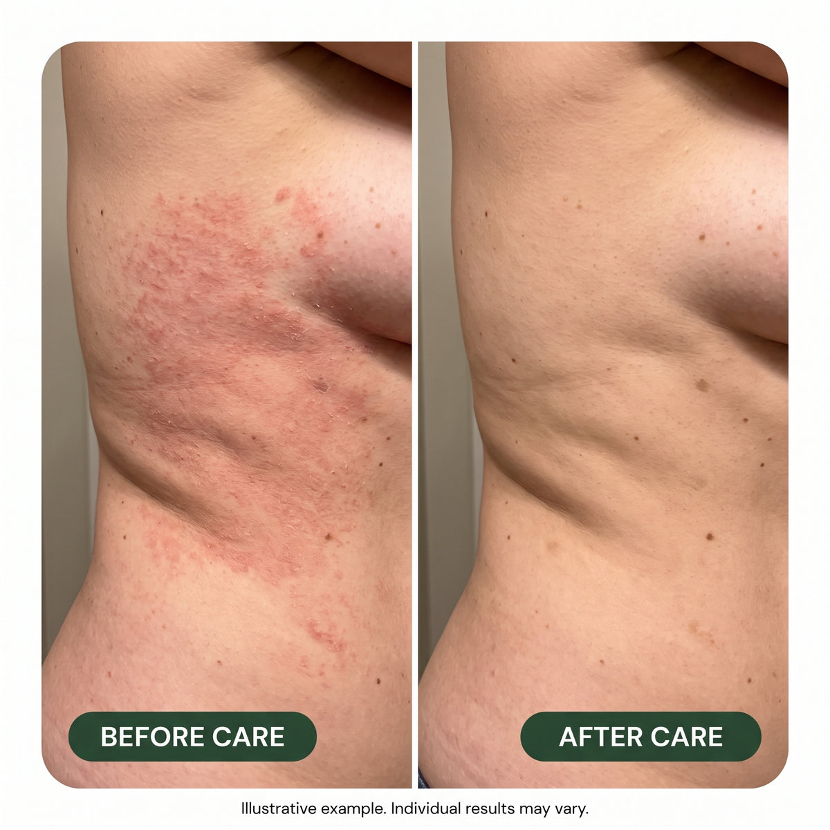 Tea Tree Antifungal Soap Bar – Deep Cleansing Skin Care